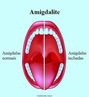 Sintomas da amigdalite aguda ou crônica, remédios e tratamen