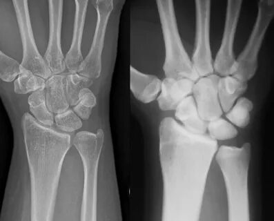 Radiocarpal Fracture Dislocation - Hand - Orthobullets