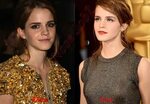 Emma Watson Nose Job - Emma Watson Before and After Plastic 