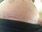 Real c-section scar photos prove every caesarean is differen