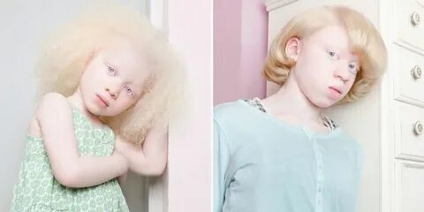 Люди-альбиносы: проект фотографа, которой не все равно (фото