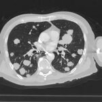 How to interpret CT scans of your lung