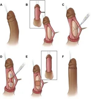 Journal Sexual Med. в Твиттере: "Augmentation #phalloplasty 
