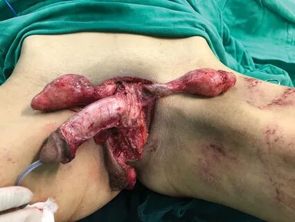 Complete Penile and Scrotum Skin Degloving Injury - MediHelp