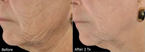 Genius ® Microneedling with RF Before and After Pictures Cas