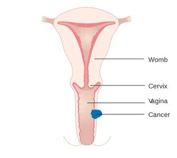 File:Diagram showing stage 2 vaginal cancer CRUK 210.svg - W
