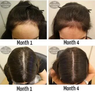 Male Pattern Hair Growth In Women : Hirsutism - abnormal hai