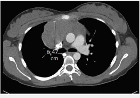 CT chest showing an anterior mediastinal mass measuring 6.47