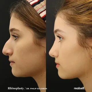 Rhinoplasty Before and After Rhinoplasty before and after, R