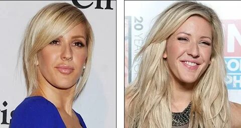 Bibir Jadi Lebih Tebal, Ellie Goulding Lakukan Operasi Plast