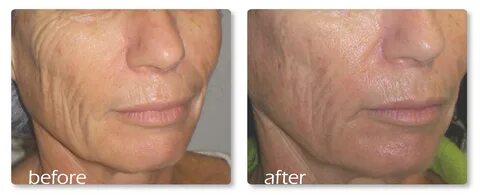 ST - lax and sagging skin around cheeks and folds at lower e