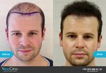 Hair Transplant Pictures: Before & After