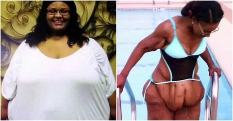 Woman Who Lost 200 lbs Is Unrecognizable After Having Mounds