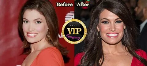 Kimberly Guilfoyle Plastic Surgery Before and After Pictures