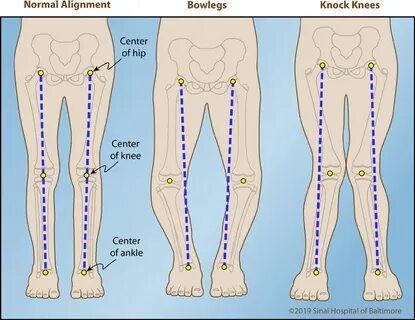 Knock Knees International Center for Limb Lengthening