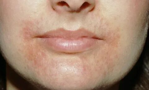 Causes of Dry Skin Around Mouth, Lips or Nose - Skincarederm