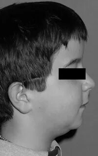 Image: Пикнодизостоз (микрогнатия нижней челюсти) - Справочн