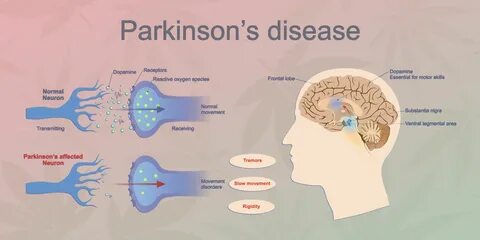What Is Parkinson's Disease - Parkinson's Disease - VCE Psyc