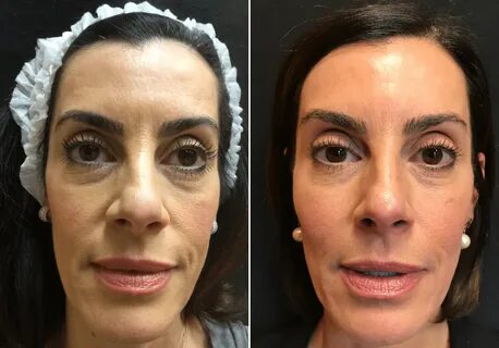 NonSurgical Facelift with Botox, Voluma, and Sculptra Before