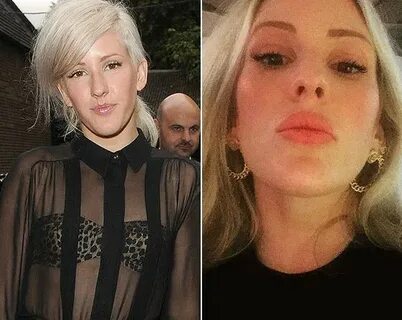 Ellie Goulding before and after lip surgery (4) Celebrity pl