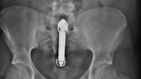 Man Live-Tweets Dildo Mishap Complete With X-Ray Photo Proof