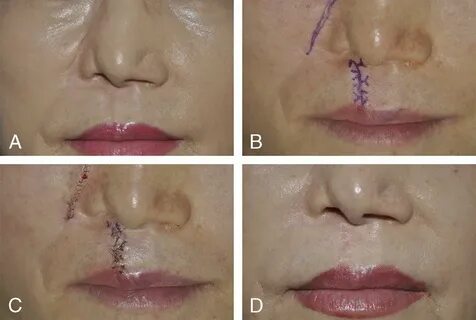 A 61-year-old woman complained of a depressed scar on the...