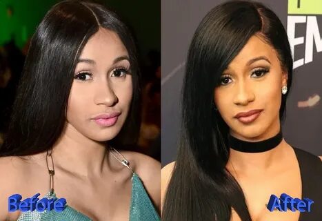 Cardi B Before and After Cosmetic Surgery - Plastic Surgery 