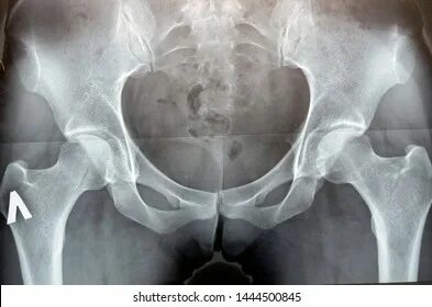 Similar Images, Stock Photos & Vectors of Anterior posterior