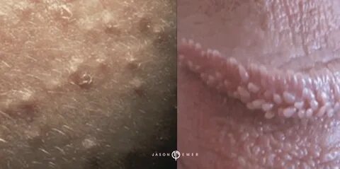 Pearly penile papules on shaft 🔥 Pearly Penile Papule Articl