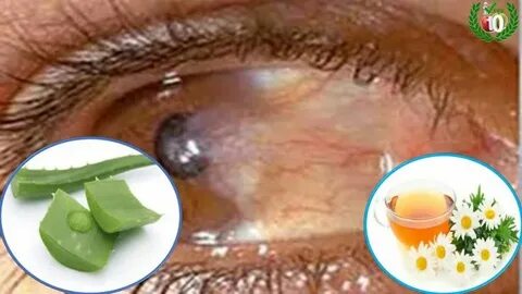 🍏 🍎 Como eliminar las carnosidades de los ojos de forma natu