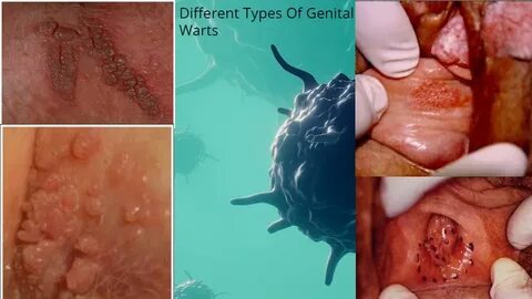 Genital Warts: Symptoms, Causes, Complications & Natural Tre