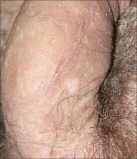 Hyperpigmentation of the median raphe of the penis. Download
