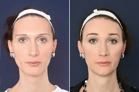 Thoughts on facial feminization surgery/transformations? My 