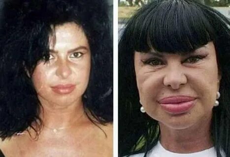 21 Celebrity Before-And-After Plastic Surgery Disasters - Ah