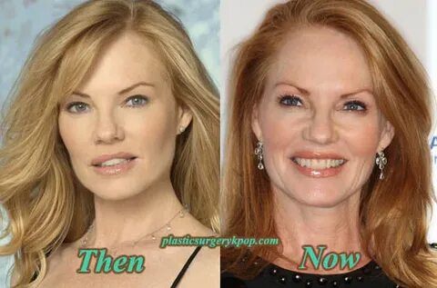 Marg Helgenberger Plastic Surgery Before and After Photos