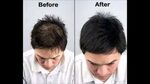 I Just Want My Hair To Grow Back - How To Stop Dht Hair Loss