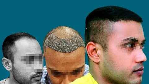 Hair Transplant Result ( Before & After ) Dense Hair Transpl