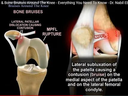 Avulsion injuries around the Knee - OrthopaedicPrinciples.co