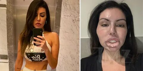 Instagram Model, Liziane Gutierrez’s Face Swollen After Plas