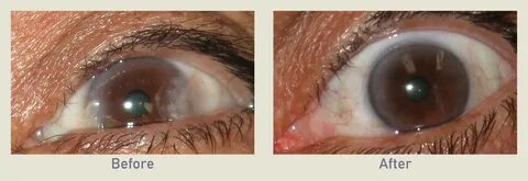 Pterygium Removal Before & After Photo Gallery Los Angeles