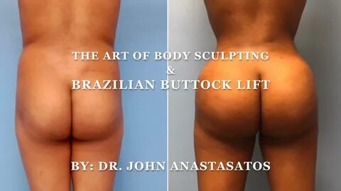 Brazilian Butt Lift and Body Sculpting - Video - RealSelf