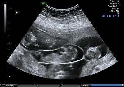 Pin on Ultrasound Photos of Twins & Multiples