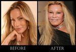 jocelyn wildenstein, before and after nose job plasticsurger