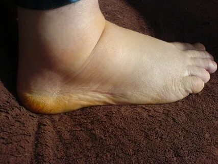 File:Geschwollener menschlicher Fuß.JPG - Wikimedia Commons