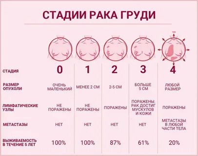 Метастазы в лимфоузлах при раке молочной железы