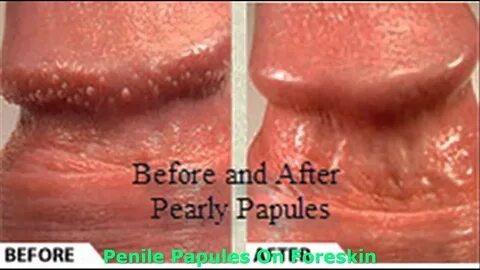 Pearly Penile Papules Treatment Home - YouTube