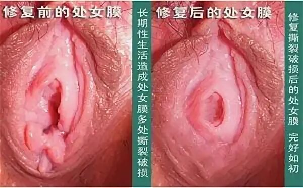 处 女 膜,阴 道 图.