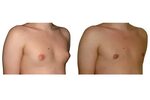 Gynekomastia (enlarged breasts in men) - Vienna - Dr. Turkof