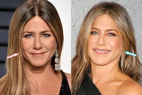 Jennifer Aniston Plastic Surgery: Before and After Pictures