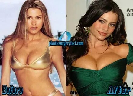 Sofia Vergara Plastic Surgery Before and After Photos - Plas